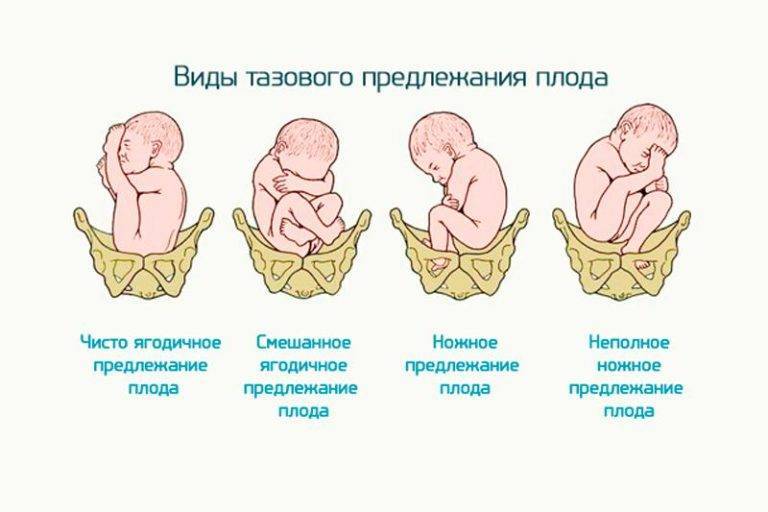 Плод расположен в правой части живота. беременность — определяем положение ребенка в животе без узи