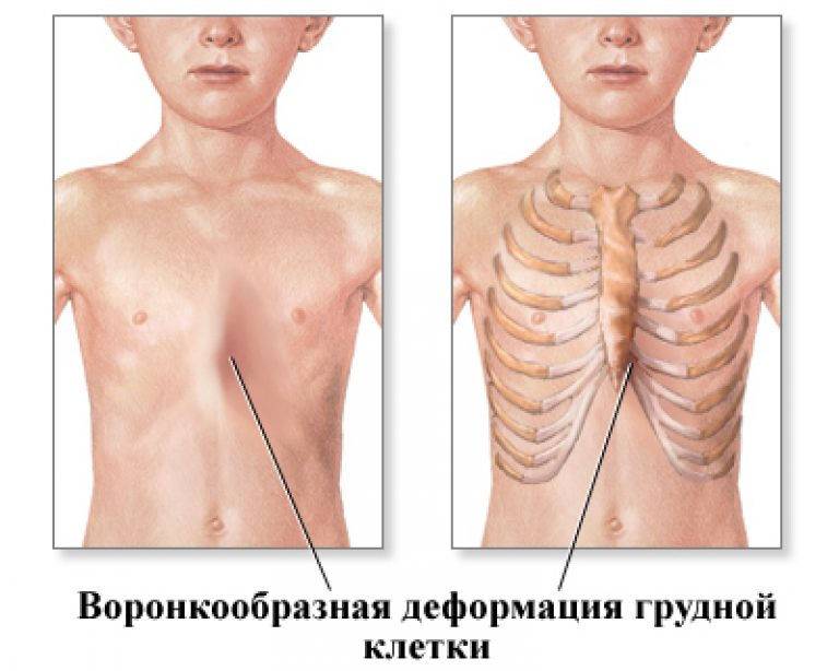 Энцефалопатия новорожденных: что это такое, причины, симптомы и способы лечения - московский центр остеопатии