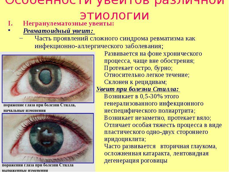 Заболевания сетчатки глаз - симптомы, лечение