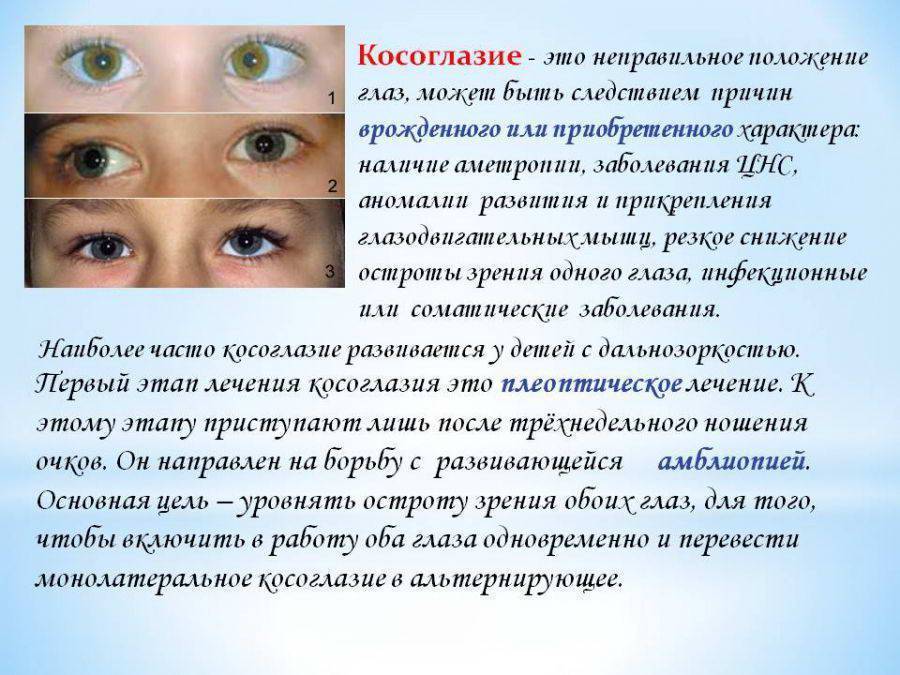 Лечение косоглазия у детей в москве – методы исправления без операции – клиника «новый взгляд»