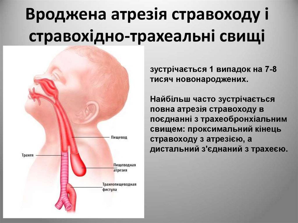 Атрезия пищевода у новорожденных - medside.ru