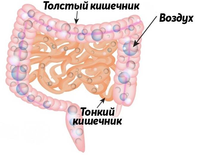 Пневматизация петель кишечника