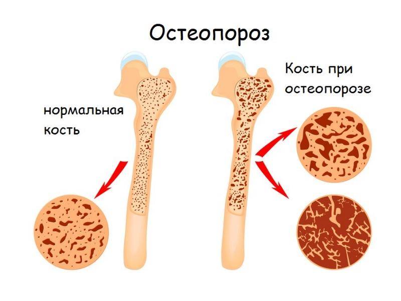 Классификация остеопороза | центр дикуля