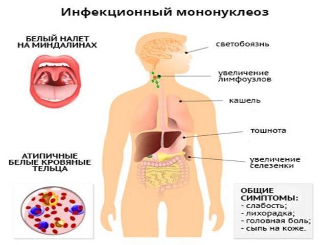 Энтеровирусные инфекции
