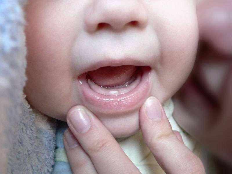 Задержка прорезывания молочных зубов