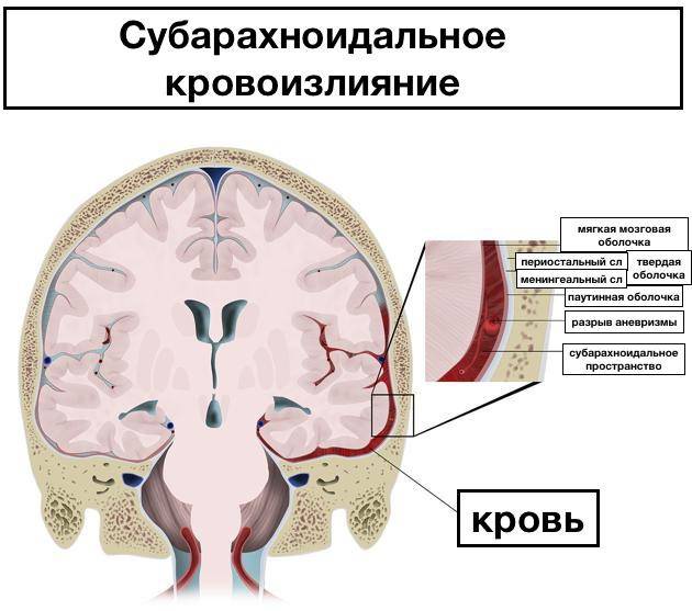 Кровоизлияние в желудочки головного мозга: причины, симптомы, диагностика и лечение