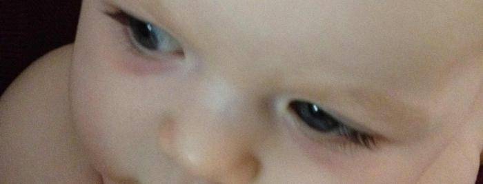 Синяки под глазами у ребенка — что к ним приводит и что они означают