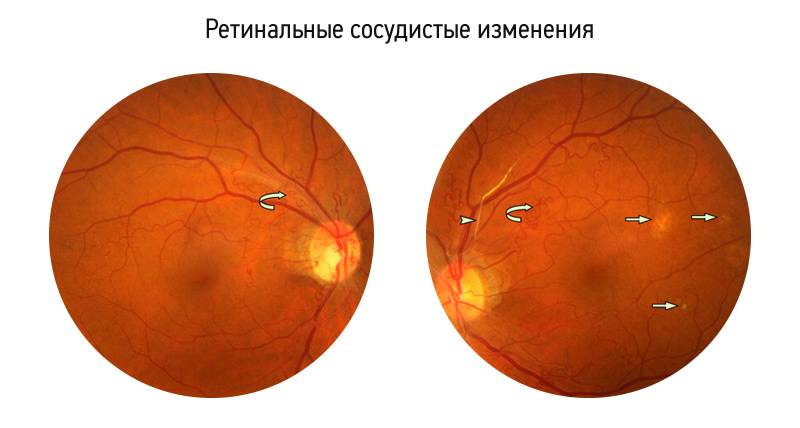 Задняя агрессивная ретинопатия недоношенных - энциклопедия ochkov.net