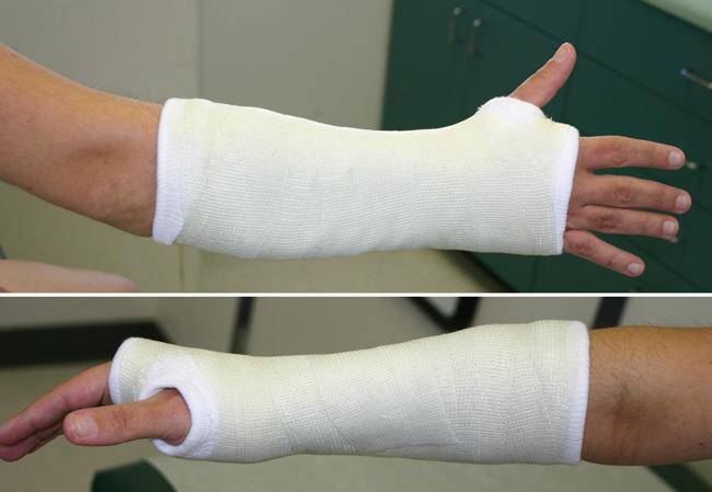 Перелом руки или запястья: лечение и реабилитация – напоправку – напоправку