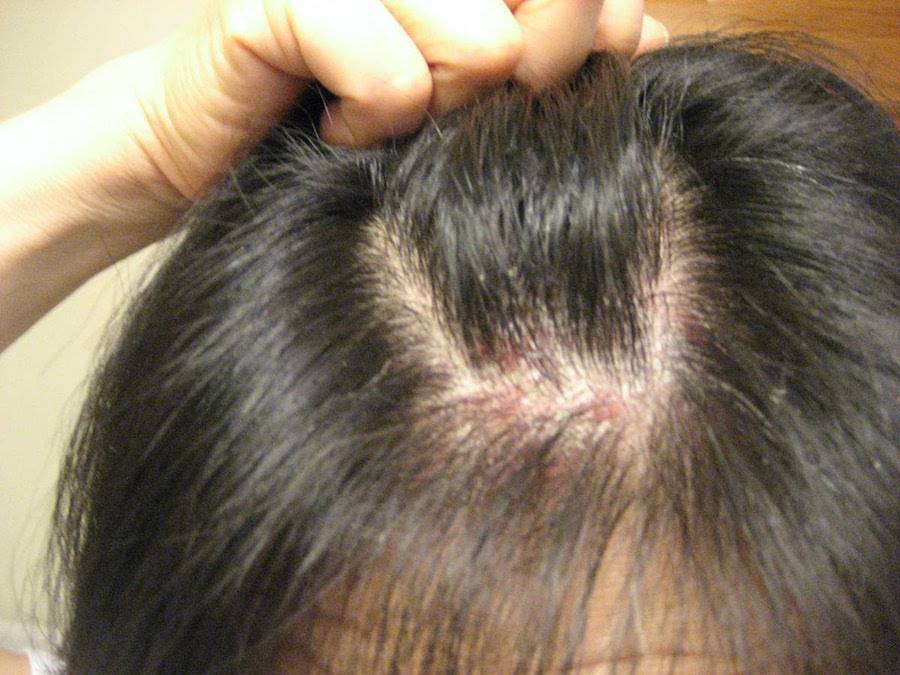 Грибок кожи головы: симптомы, лечение и профилактика