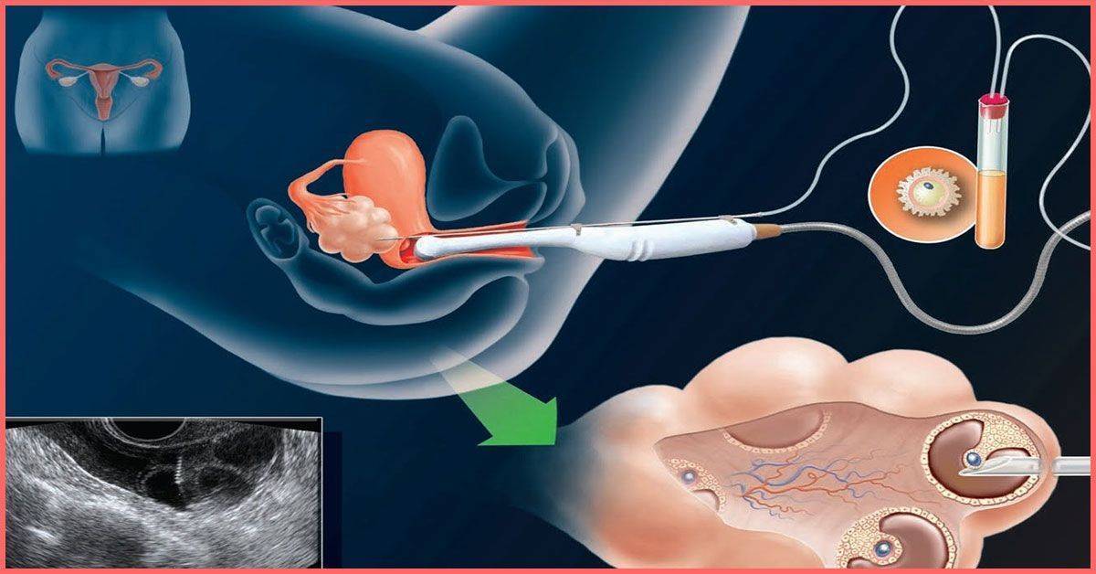 Подготовка к криопереносу эмбрионов: условия и тактики