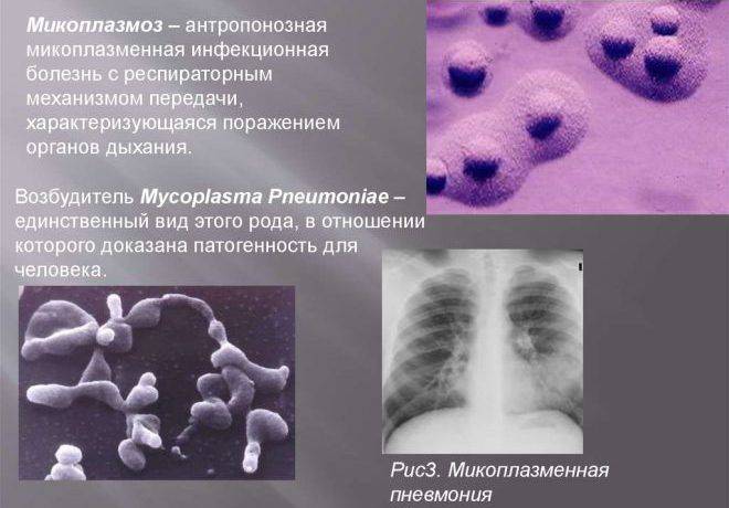 Микоплазменная инфекция дыхательных путей у детей. признаки и лечение