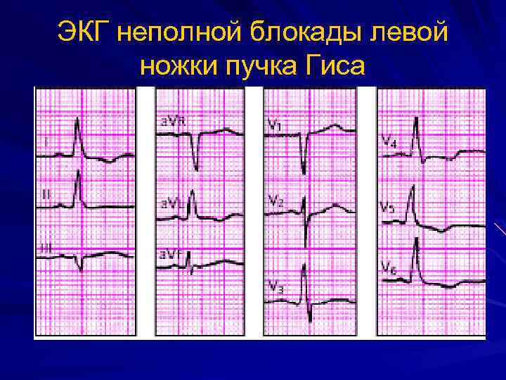 Сердце неполная блокада правой ножки гиса