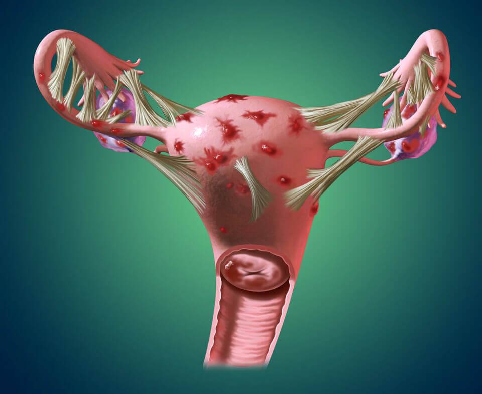 Аденоматоз матки: лечение и диагностика аденоматоза эндометрии матки в европейской клинике