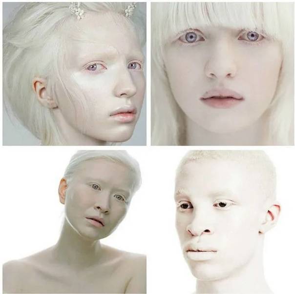 Альбинизм — википедия. что такое альбинизм