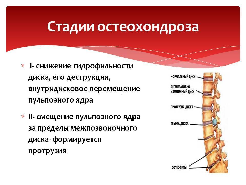 Патологии позвоночника - дегенеративно-дистрофические заболевания — комунальне  некомерційне підприємство "херсонська обласна клінічна лікарня" херсонської обласної ради