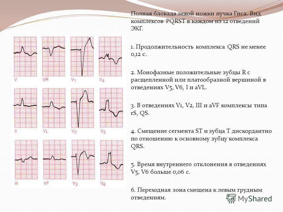 Полная блокада правой ножки пучка гиса на экг фото