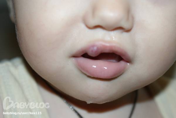 Мозоль (водянка) на губе у новорожденного: как лечить