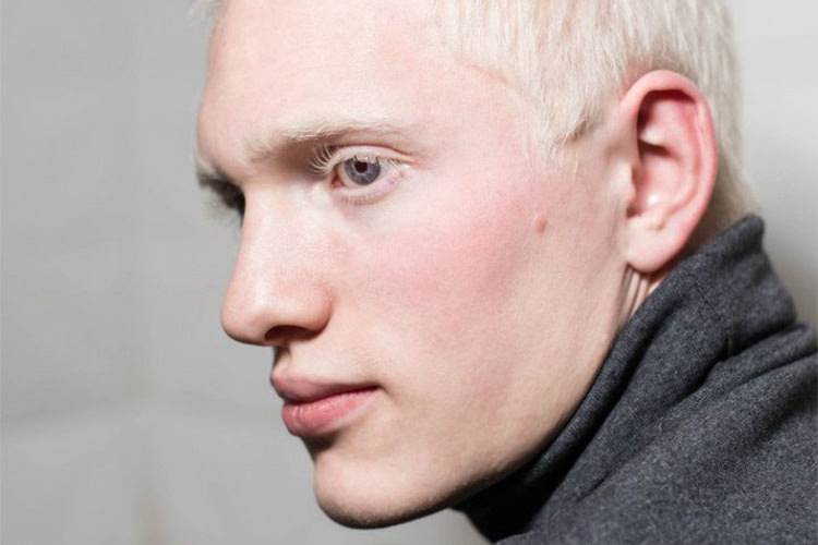 Глазной альбинизм - что это, описание, фото