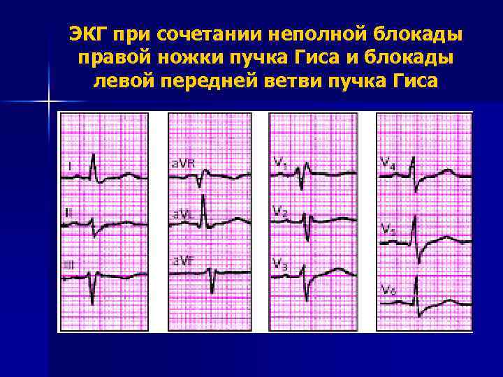 Сердечные блокады, лечение сердечных блокад в москве