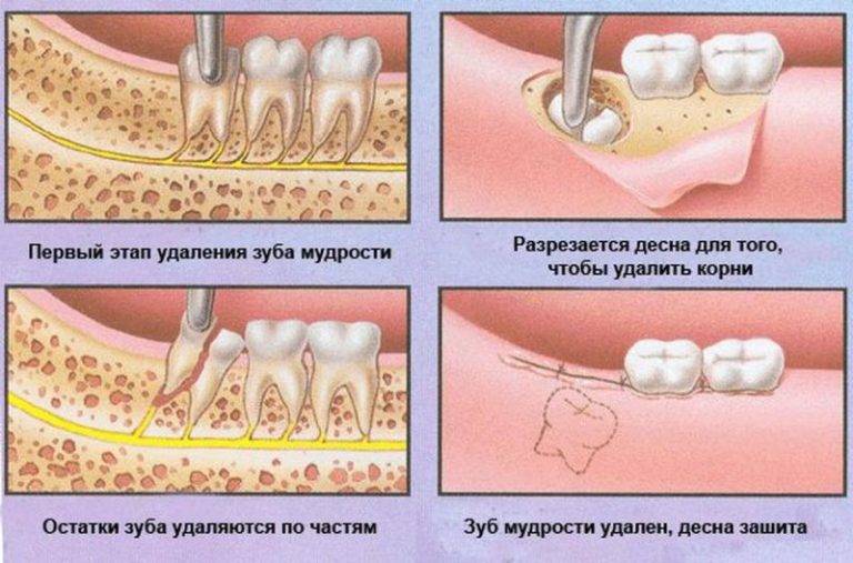 Болезни молочных зубов
