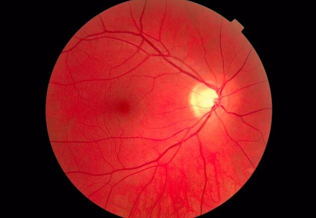 Осложненная катаракта - что это такое?