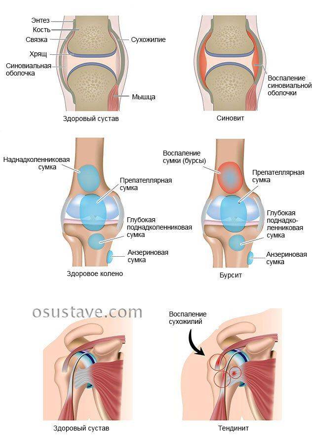 Боль в колене при приседании на корточки: лечение в москве