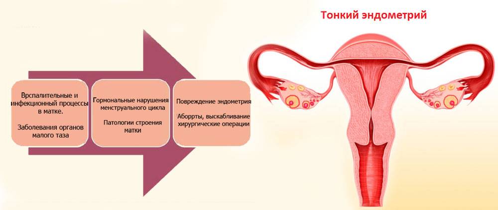 Аденоматоз матки: лечение и диагностика аденоматоза эндометрии матки в европейской клинике