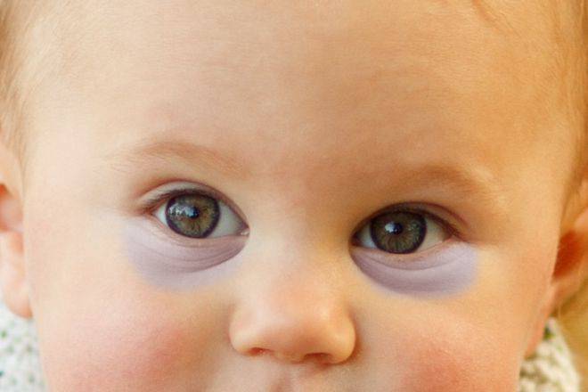 Синяки и темные круги под глазами у ребенка