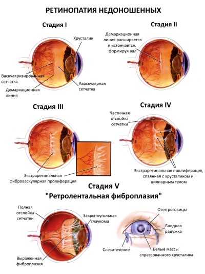 Ретинопатия глаз лечение. виды ретинопатии диагностика.