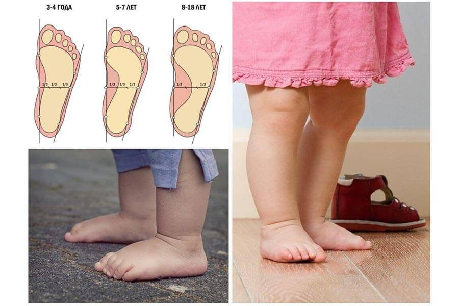 Почему ребенок ходит на цыпочках в 2-3 года (на носочках): Комаровский