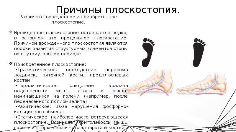 7 видов плоскостопия у детей и взрослых: симптомы и профилактика - блог стельки.ру