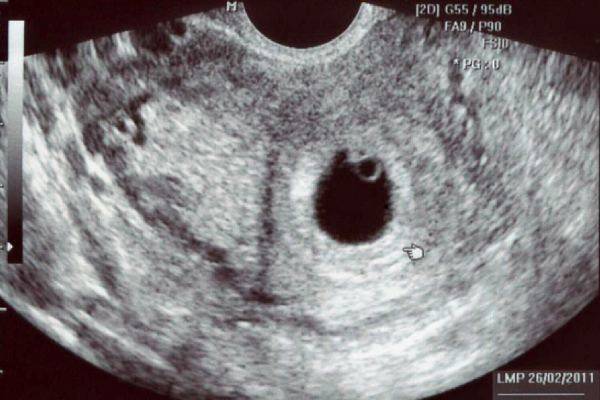 Узи на 4 неделе беременности: решаем вопрос рожать или не рожать?