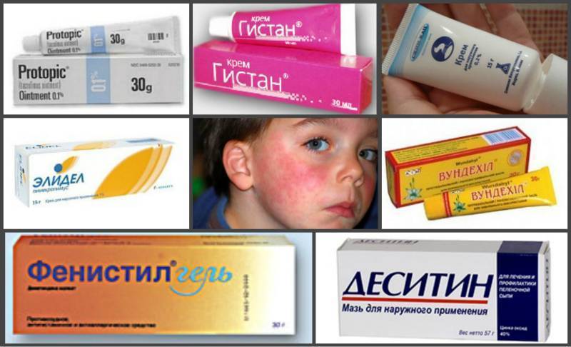 Лечение себорейного дерматита волосистой части головы: избавление от причин и симптомов