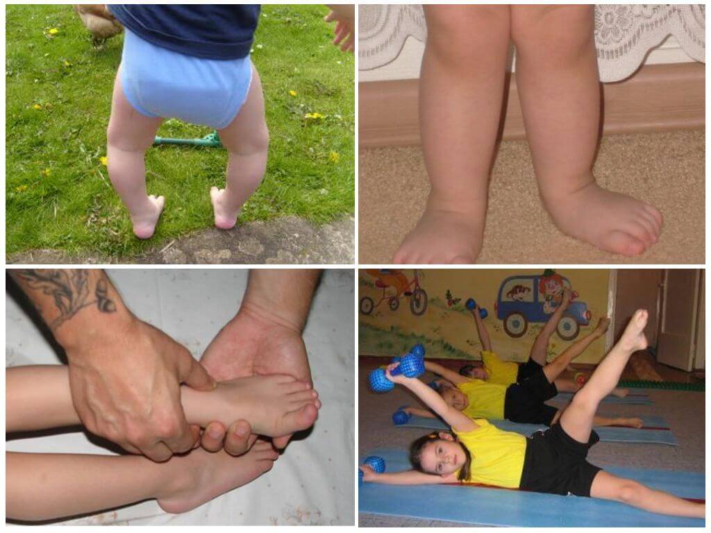 Массаж и упражнения при косолапости у детей