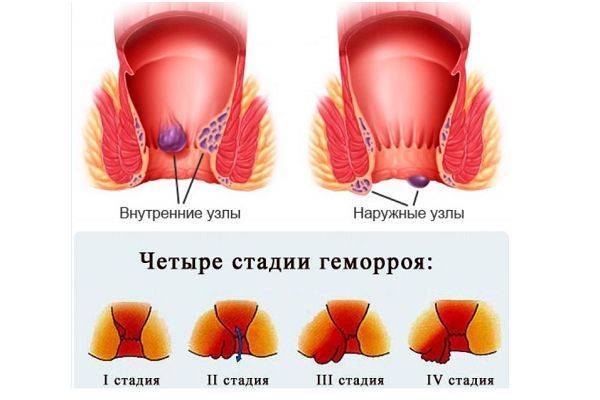 Геморрой внутренний и внешний. симптомы, признаки, стадии геморроя у мужчин и у женщин.