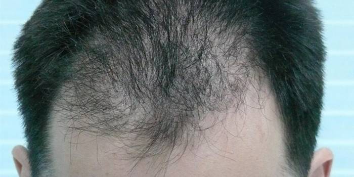 Очаговое выпадение волос