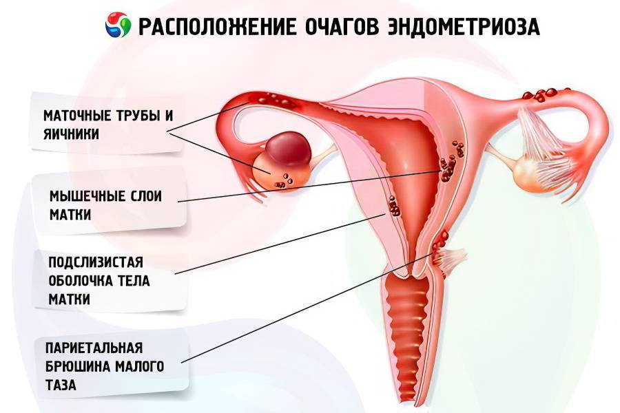 Выскабливание полости матки в москве. цена - 5000 руб. в центре «клиника abc»
