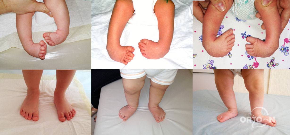 Лечение косолапости у детей: как исправить, делать массаж и определить признаки
