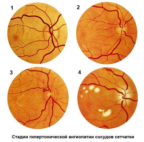 Лечение макулодистрофии сетчатки глаза в москве. стоимость лечения макулодистрофии в клинике с.федорова