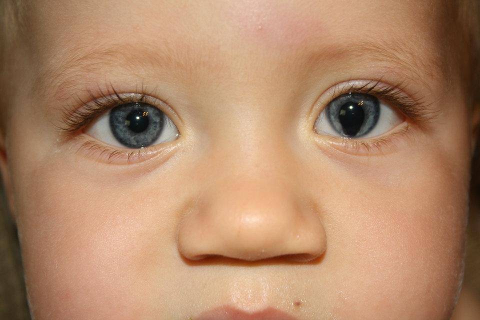 Разный размер зрачков у ребенка: причины анизокории, когда один зрачок больше другого, у грудничка или новорожденного, после падения