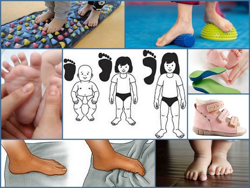 Косолапость у детей: признаки с фото, лечение с помощью упражнений, массажа и обуви