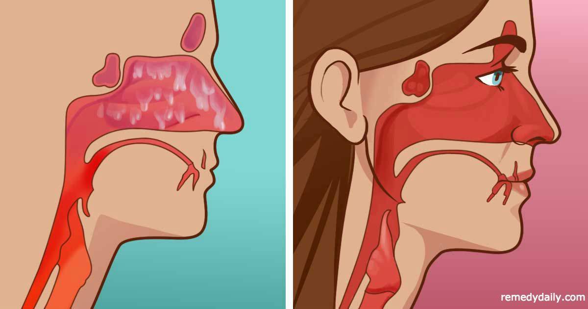Выделения из носа, глаз, горла: причины, симптомы | компетентно о здоровье на ilive