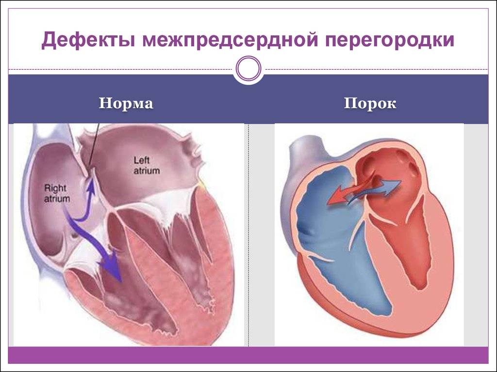 Открытое овальное окно в сердце у ребенка и у новорожденного: симптомы, причины и лечение