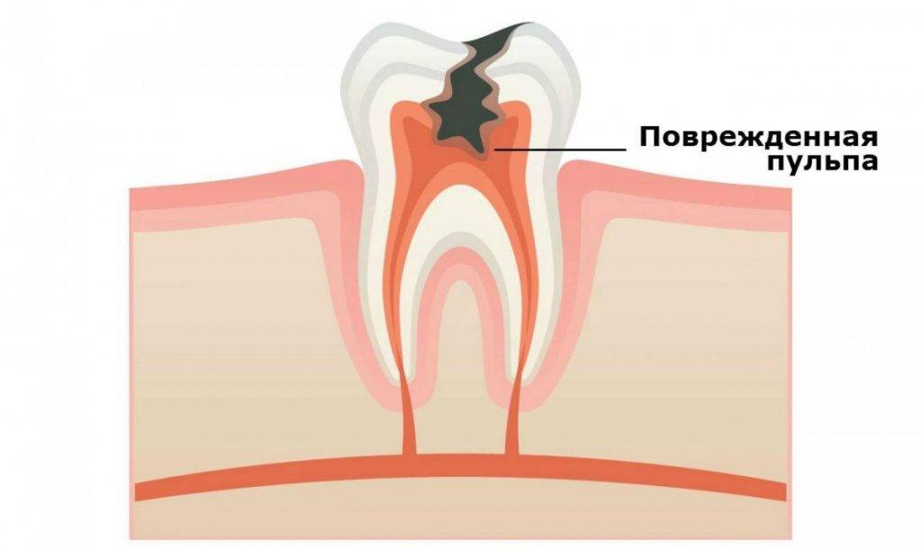 Пульпит молочных зубов у детей – лечение в краснодаре - эскулап