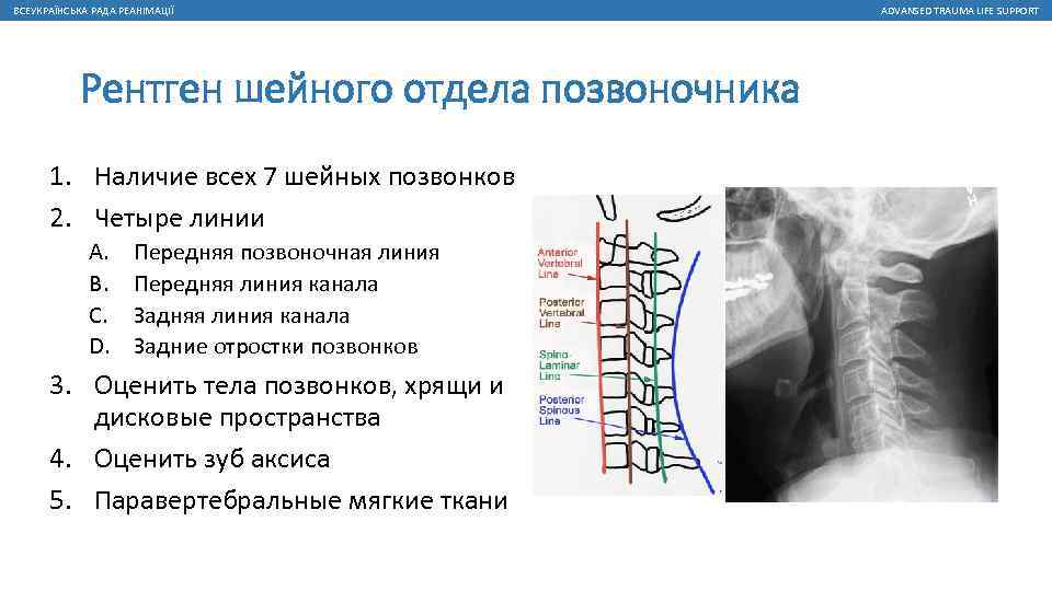 Спина бифида (расщепление позвоночника) - лечение, симптомы, причины, диагностика | центр дикуля