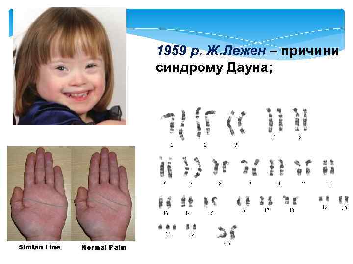 Врачи не знают, почему дети с синдромом дауна такие разные | милосердие.ru