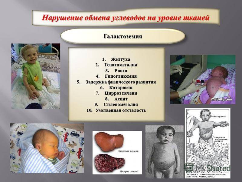 Желтуха у новорожденных - признаки, причины, симптомы, лечение и профилактика - idoctor.kz