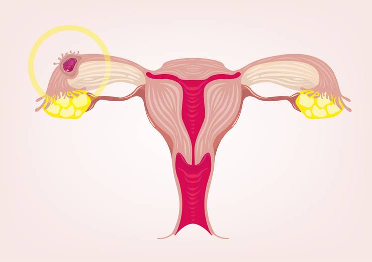 Низкий ответ яичников: чем опасен для женщин, особенности диагностики и лечения