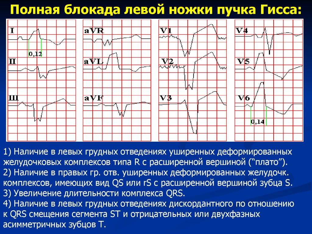 Экг блокада левой ножки пучка гиса фото